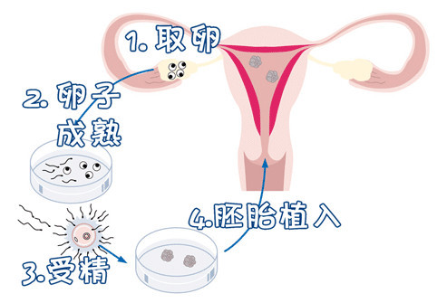 私人志愿者供卵助孕包生儿子